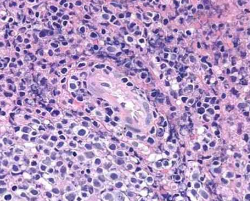 NK-92人恶性非霍奇金淋巴瘤患者的自然杀伤细胞的应用