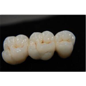 Titanium Crown And Bridge