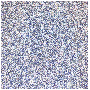 人肺腺鳞癌细胞；NCI-H596