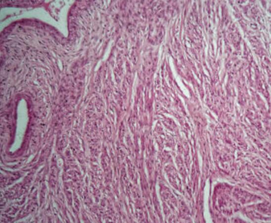 人食管纤维瘤细胞
