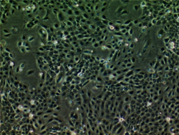 肋膜積腋(轉(zhuǎn)移)腺癌(乳腺原發(fā))MDA-MB-231