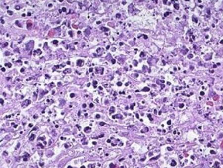 NCI-H23（人非小细胞肺癌细胞）,NCI-H23