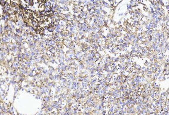 人乳腺癌血管内皮细胞,Vascular endothelial cells in human breast cancer
