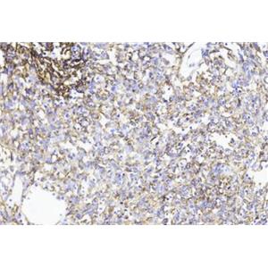 人乳腺癌血管内皮细胞,Vascular endothelial cells in human breast cancer