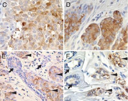 組織芯片免疫組化,Tissue chip immunohistochemistry