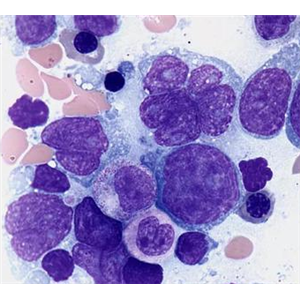 人弥漫性大B细胞淋巴瘤细胞
