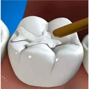 齿科填充修复树脂
