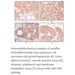 Cytokeratin (Pan),K5; DDD; EBS2; KRT5A; KRT5