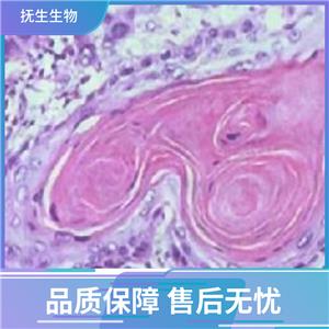 697儿童急性B淋巴细胞白血病细胞